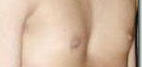 Trichterbrust (pectus excavatum)